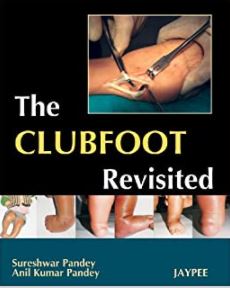 The Clubfoot Revisited