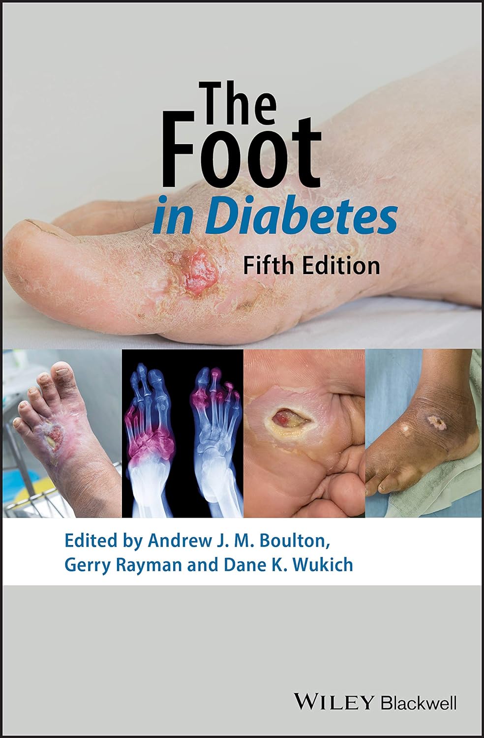 The Foot in Diabetes