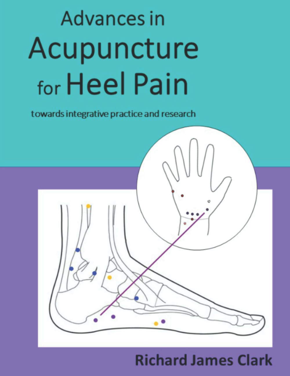 Advances in acupuncture for heel pain: towards integrative practice and research