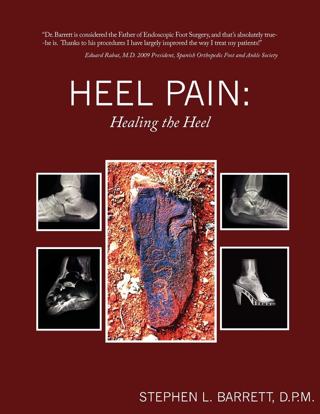 Heel Pain: Healing the Heel