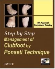 Step by Step Management of Clubfoot by Ponseti Technique